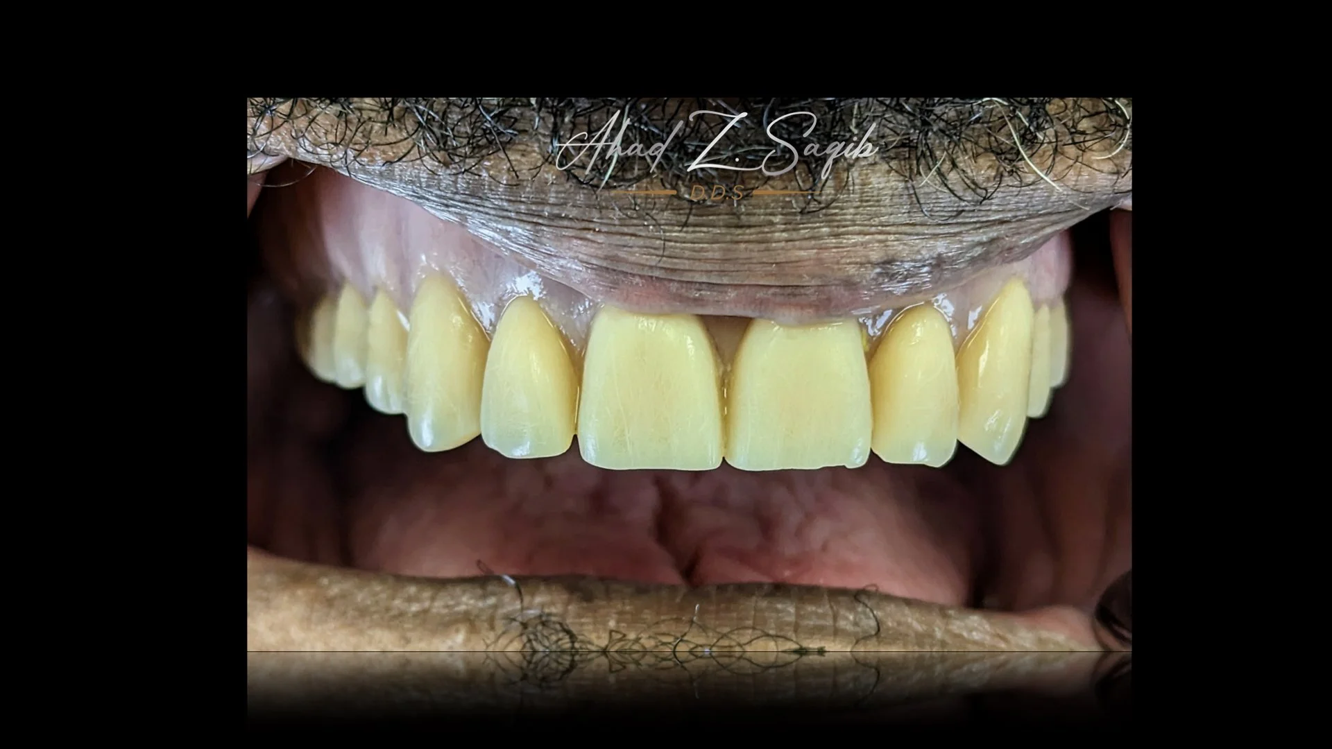 Complete Dentures — Ahad Z. Saqib, DDS